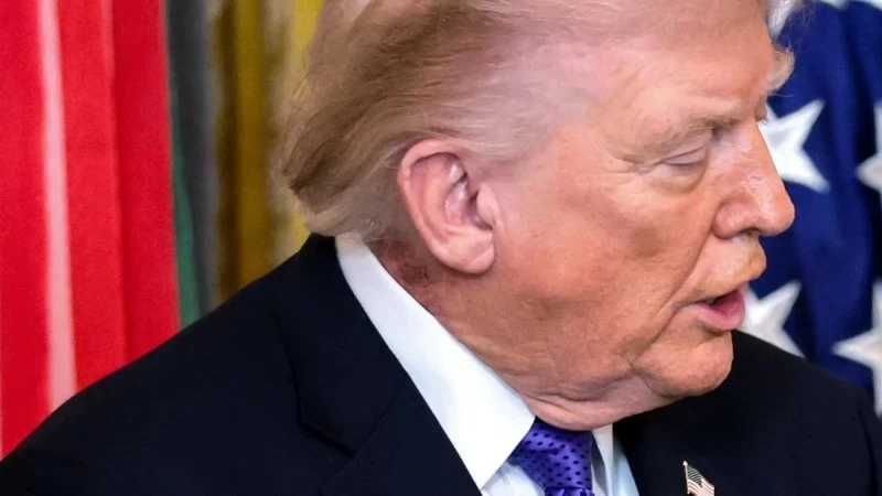 Neck rash causes controversy… President Trump’s doctor explains: ‘It’s just a common cream’ – Saudi News